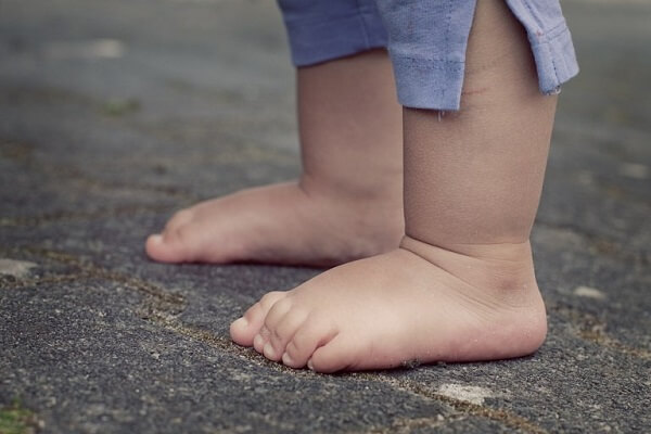 Những điều cần biết về hội chứng bàn chân bẹt ở trẻ em