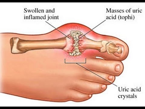 Phòng chống bệnh gút với máy chạy bộ điện